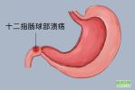 胃、十二指腸潰瘍出血