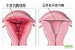 子宮內(nèi)膜厚
